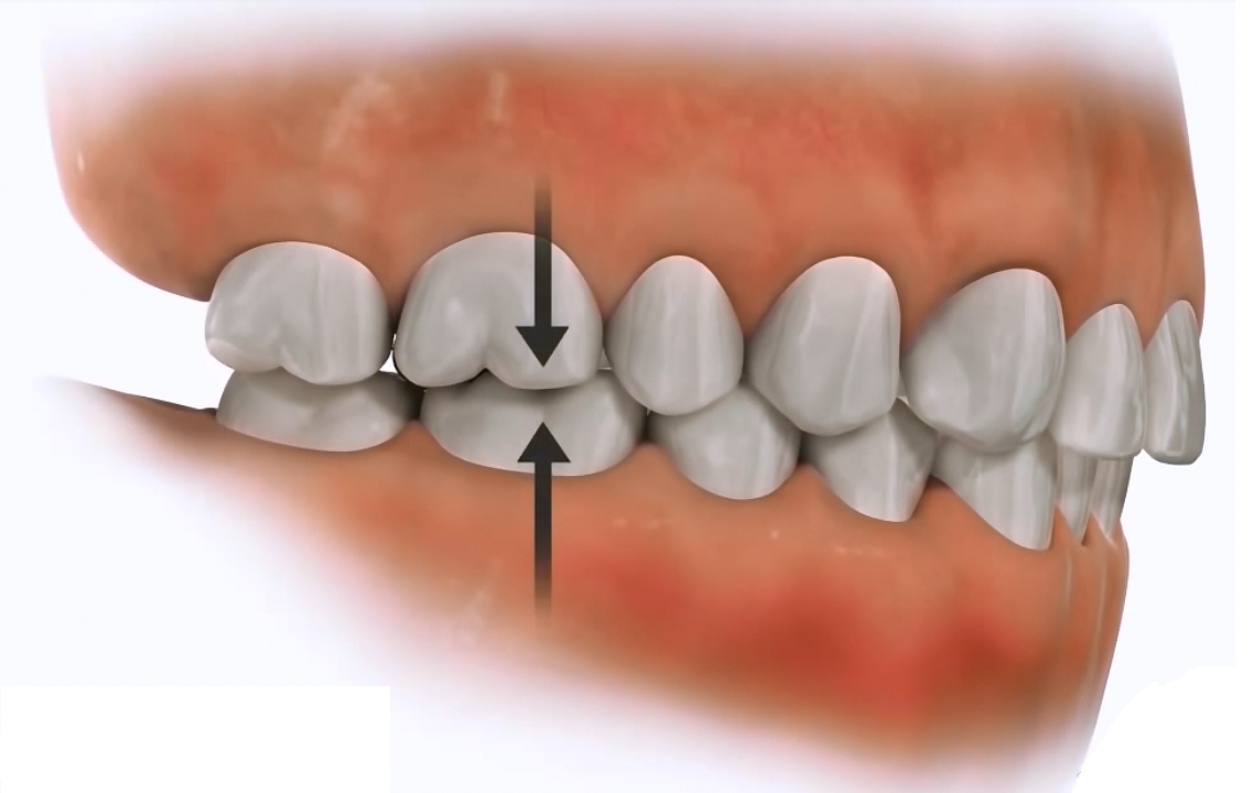 nomral occlusion